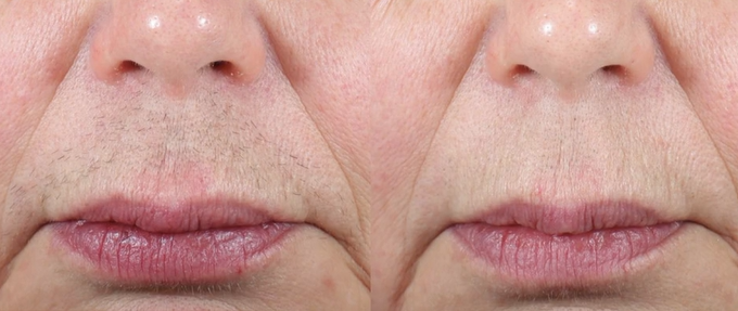 Laser-Hair-Removal-Before-After