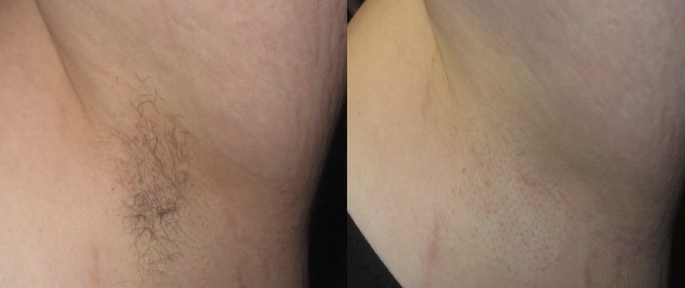 Laser-Hair-Removal-Before-After2