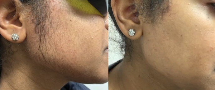 Laser-Hair-Removal