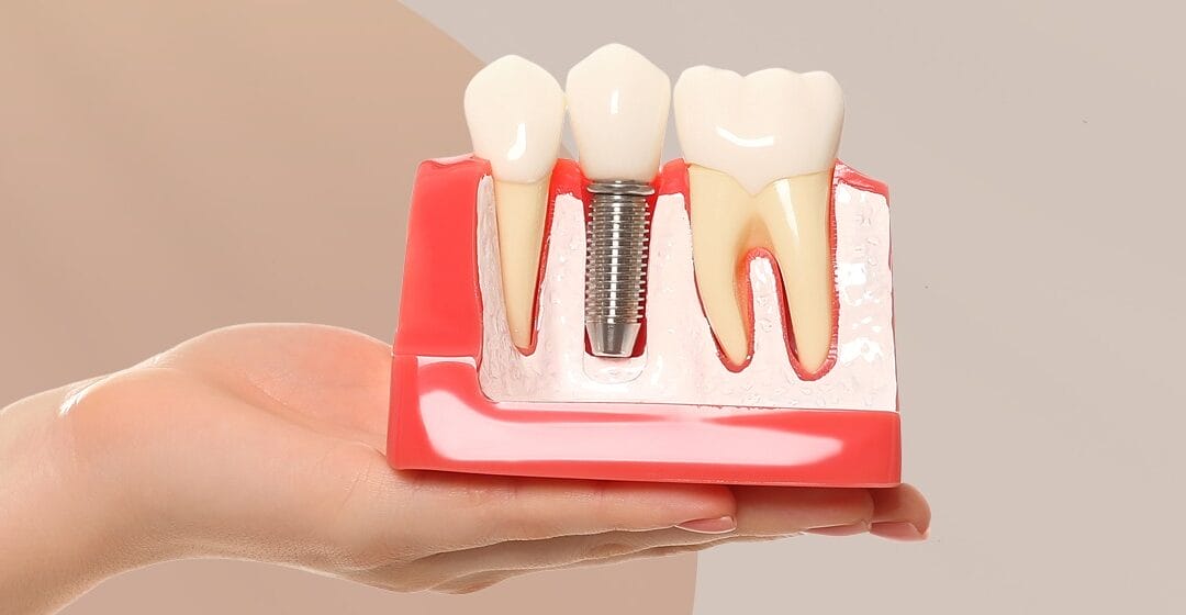 Dental Implants in Dubai: A Complete Guide to Lasting Solutions